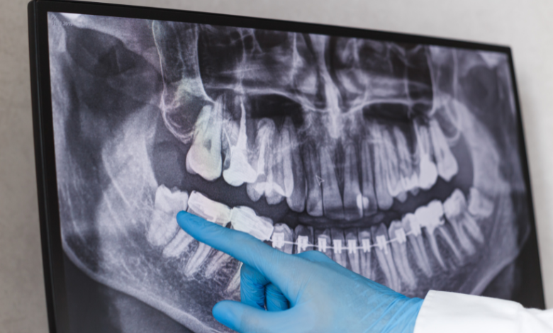 ניתוח שתלים - מה מותר לאכול אחרי ניתוח כירורגי אצל רופא שיניים