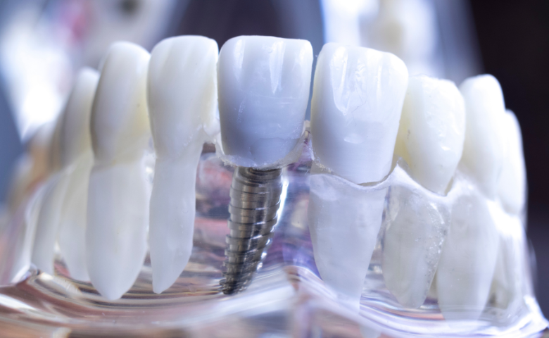 השתלות שיניים – כל מה שרציתם לדעת