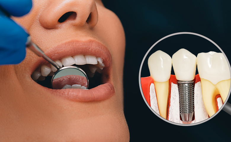 השתלת שיניים ביום אחד – מחירון מקיף שיחסוך לכם כסף