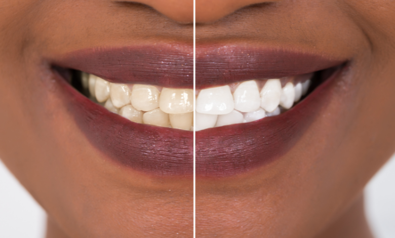 הלבנת שיניים – כל מה שלא ידעתם על הלבנה אצל רופא שייניים
