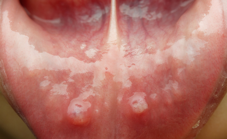 אפטה בפה או סרטן הפה - כיצד מבדילים ואיך מאבחנים