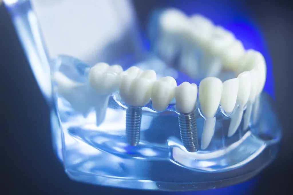 סוגי השתלות שיניים – סוגי שתלים
